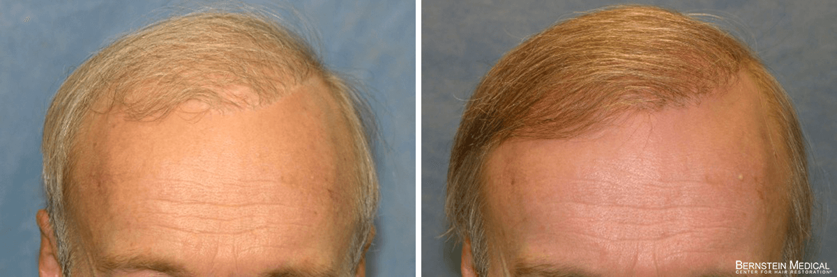 Bernstein Medical - Patient DGT Before and After Hair Transplant Photo 