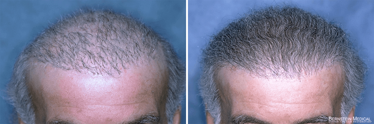 Bernstein Medical - Patient JHG Before and After Hair Transplant Photo 