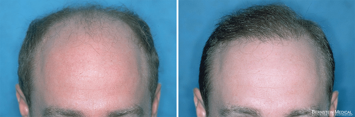 Bernstein Medical - Patient JIH Before and After Hair Transplant Photo 