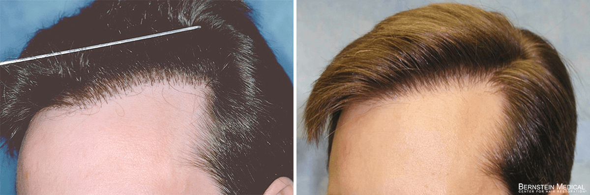 Bernstein Medical - Patient LJZ Before and After Hair Transplant Photo 