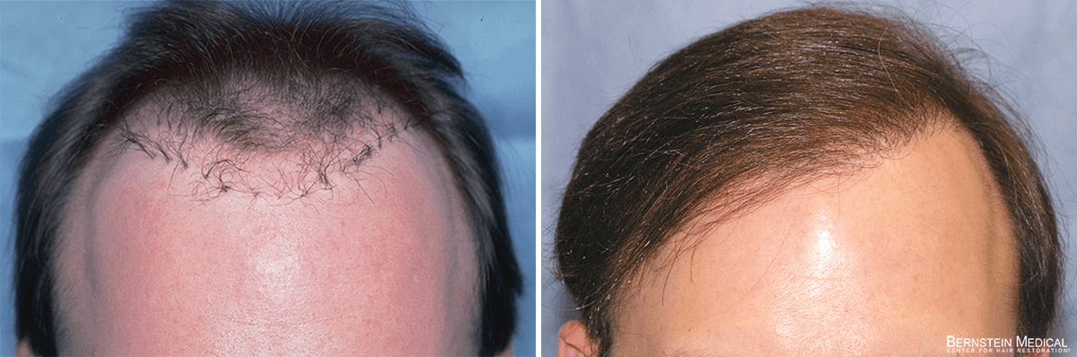 Bernstein Medical - Patient LKE Before and After Hair Transplant Photo 