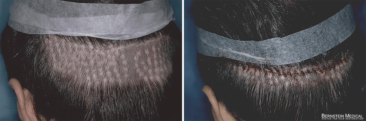 Bernstein Medical - Patient QMB Before and After Hair Transplant Photo 
