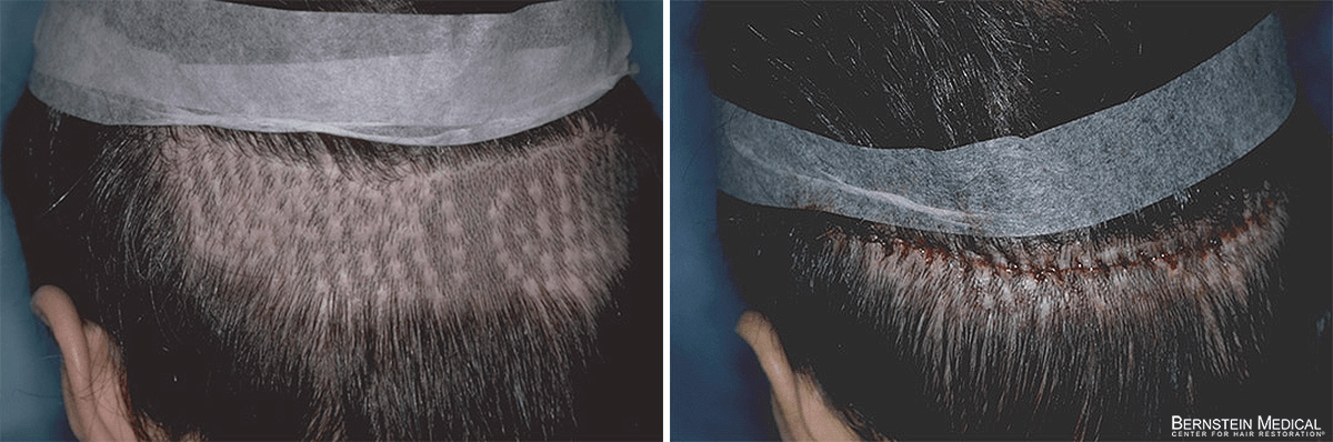 Bernstein Medical - Patient QMB Before and After Hair Transplant Photo