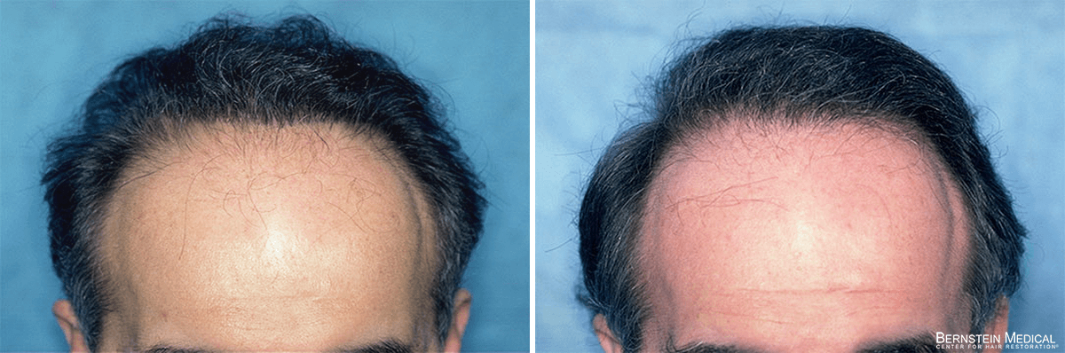 Bernstein Medical - Patient QNI Before and After Hair Transplant Photo 
