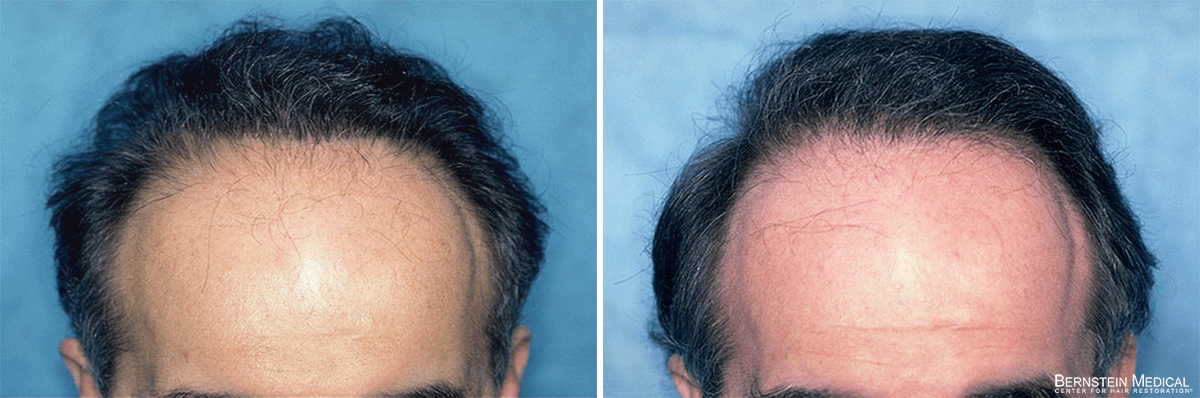 Bernstein Medical - Patient QNI Before and After Hair Transplant Photo