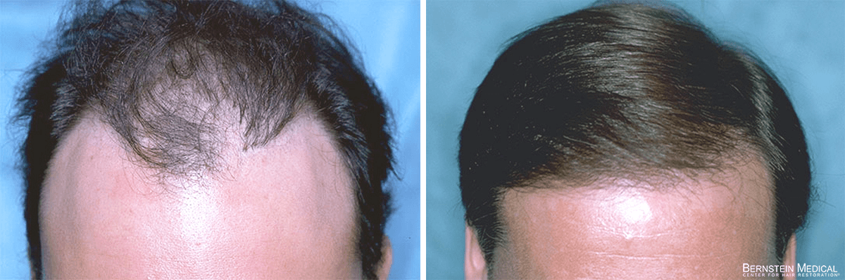 Bernstein Medical - Patient RPI Before and After Hair Transplant Photo 