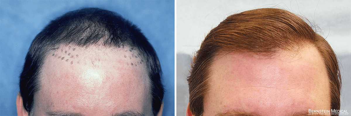 Bernstein Medical - Patient VRI – Repair Before and After Hair Transplant Photo 