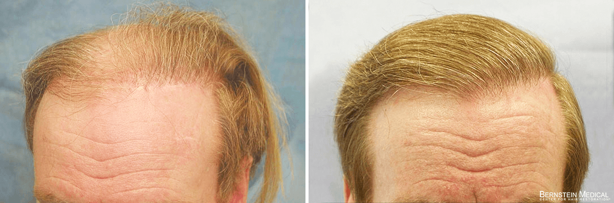 Bernstein Medical - Patient VSQ Before and After Hair Transplant Photo 