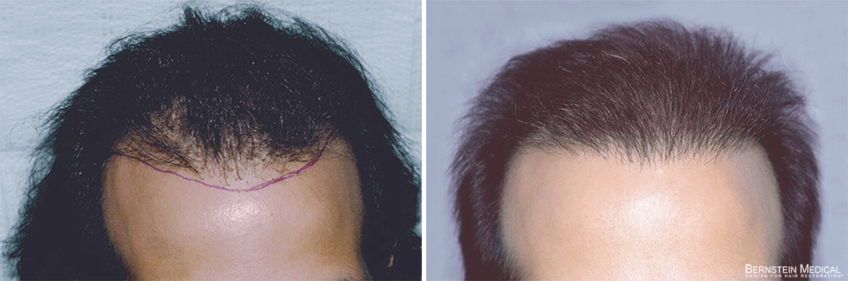 Bernstein Medical - Patient ZAO Before and After Hair Transplant Photo 
