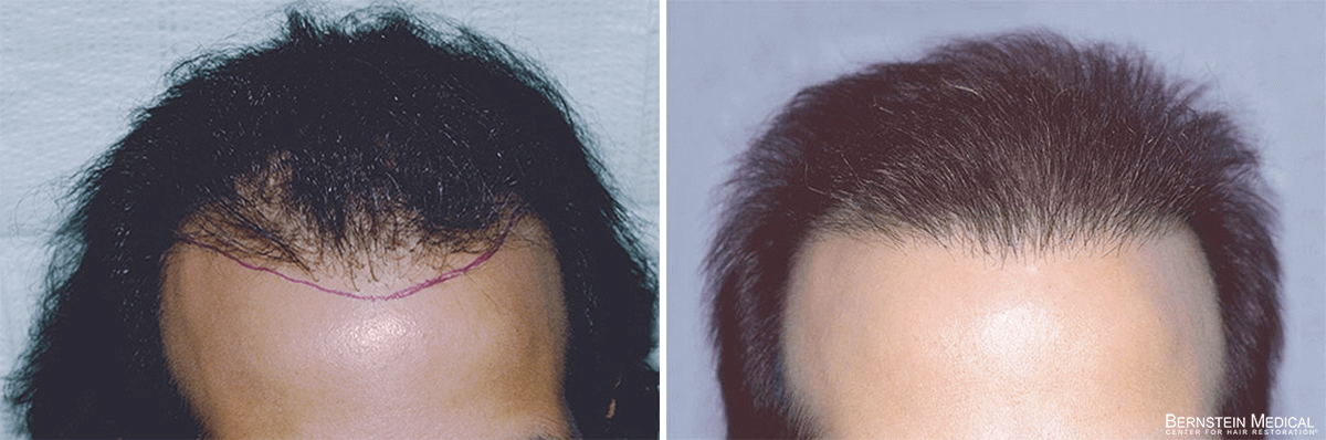 Bernstein Medical - Patient ZAO Before and After Hair Transplant Photo