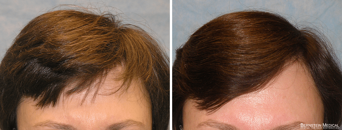 Bernstein Medical - Patient AAL Before and After Hair Transplant Photo 