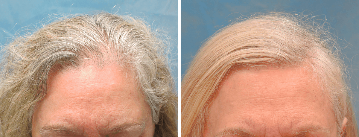 Bernstein Medical - Patient BWO Before and After Hair Transplant Photo 