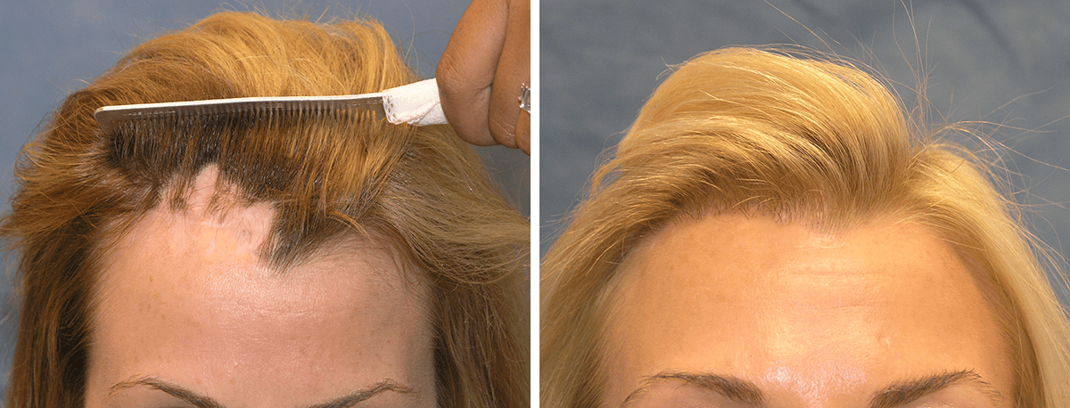 Bernstein Medical - Patient BZS Before and After Hair Transplant Photo