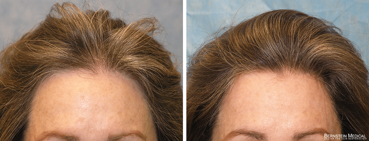 Bernstein Medical - Patient EHA Before and After Hair Transplant Photo 