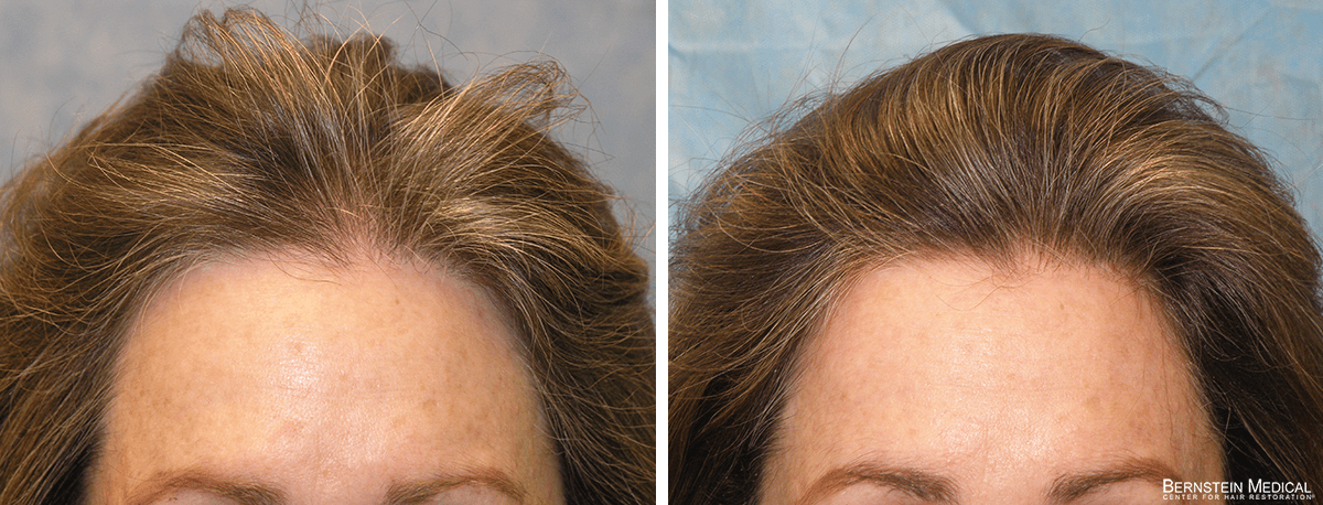 Bernstein Medical - Patient EHA Before and After Hair Transplant Photo