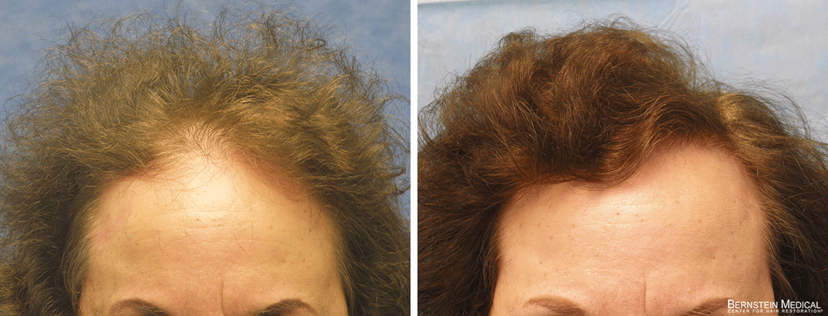 Bernstein Medical - Patient FBK Before and After Hair Transplant Photo 