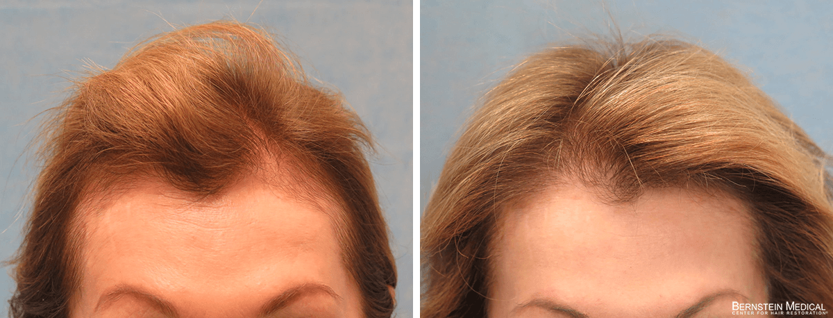 Bernstein Medical - Patient FOM Before and After Hair Transplant Photo 