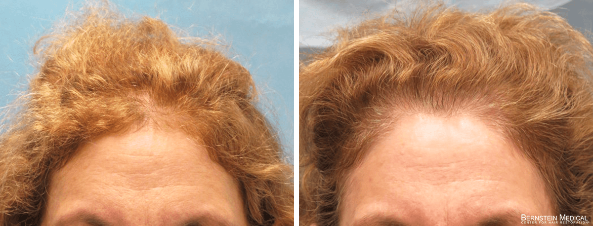 Bernstein Medical - Patient FTI Before and After Hair Transplant Photo 