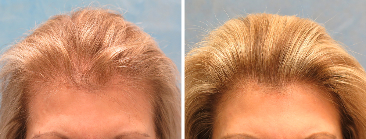 Bernstein Medical - Patient GBE Before and After Hair Transplant Photo 