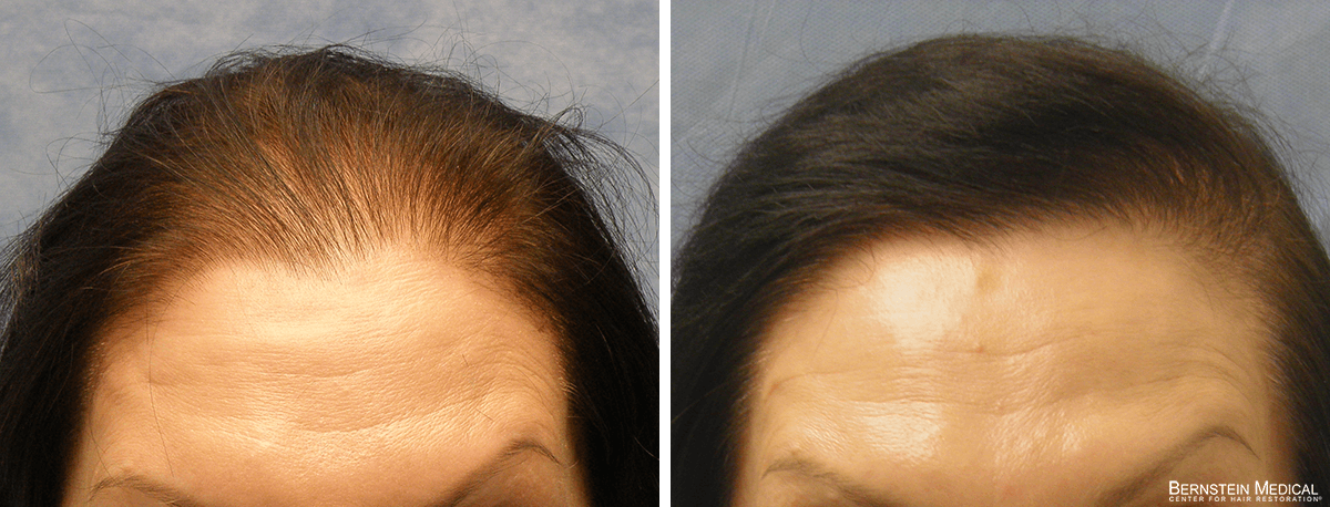 Bernstein Medical - Patient JAF Before and After Hair Transplant Photo