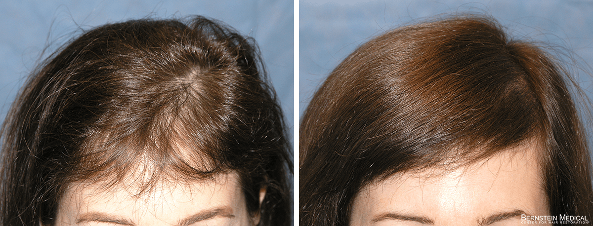 Bernstein Medical - Patient JAK Before and After Hair Transplant Photo 
