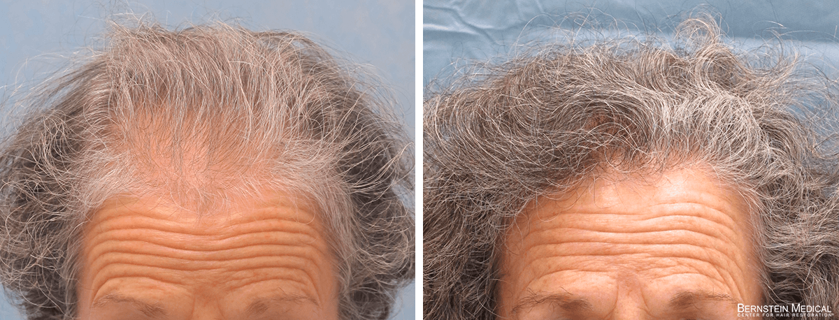 Bernstein Medical - Patient KLR Before and After Hair Transplant Photo 