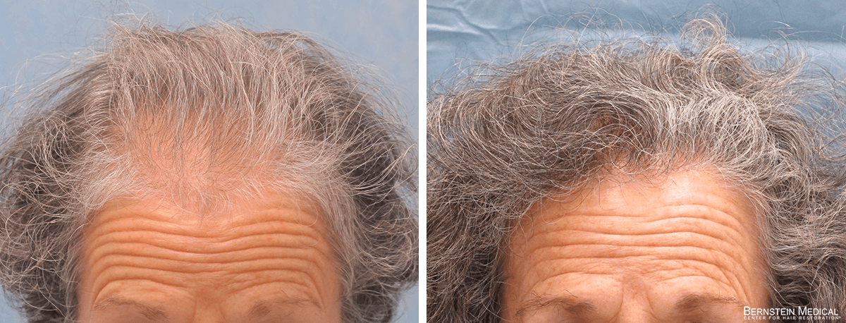 Bernstein Medical - Patient KLR Before and After Hair Transplant Photo