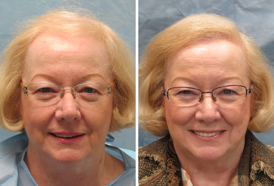 Bernstein Medical - Patient LUZ Before and After Hair Transplant Photo