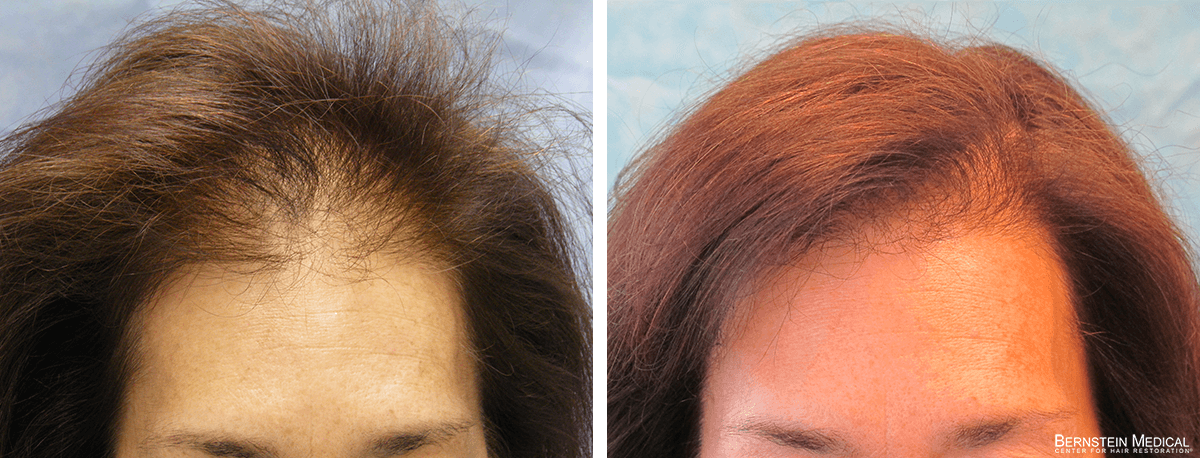 Bernstein Medical - Patient MPV Before and After Hair Transplant Photo 