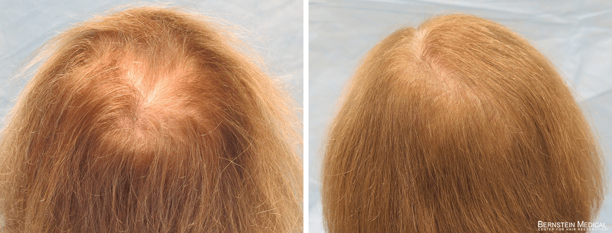 Bernstein Medical - Patient OLL Before and After Hair Transplant Photo 