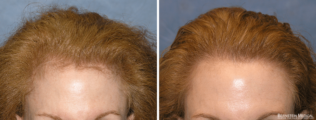 Bernstein Medical - Patient RAS Before and After Hair Transplant Photo 