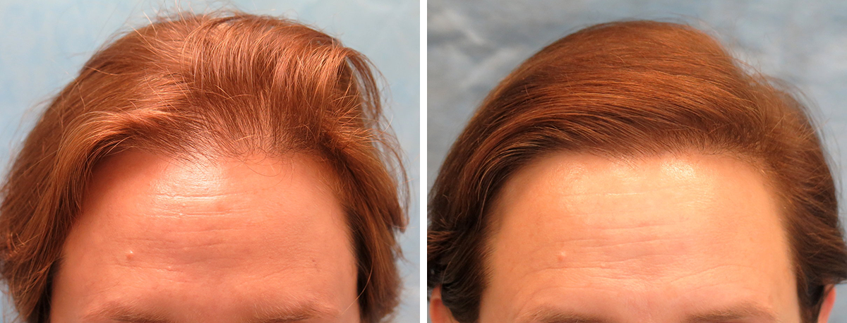 Bernstein Medical - Patient ANJ Before and After Hair Transplant Photo 