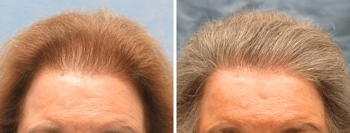 Bernstein Medical - Patient FPK Before and After Hair Transplant Photo 