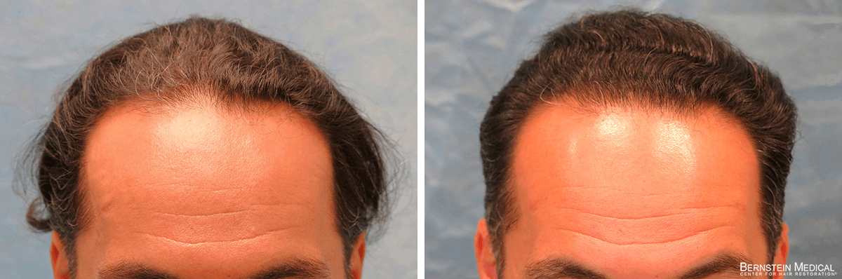 Bernstein Medical - Patient ZNQ Before and After Hair Transplant Photo 