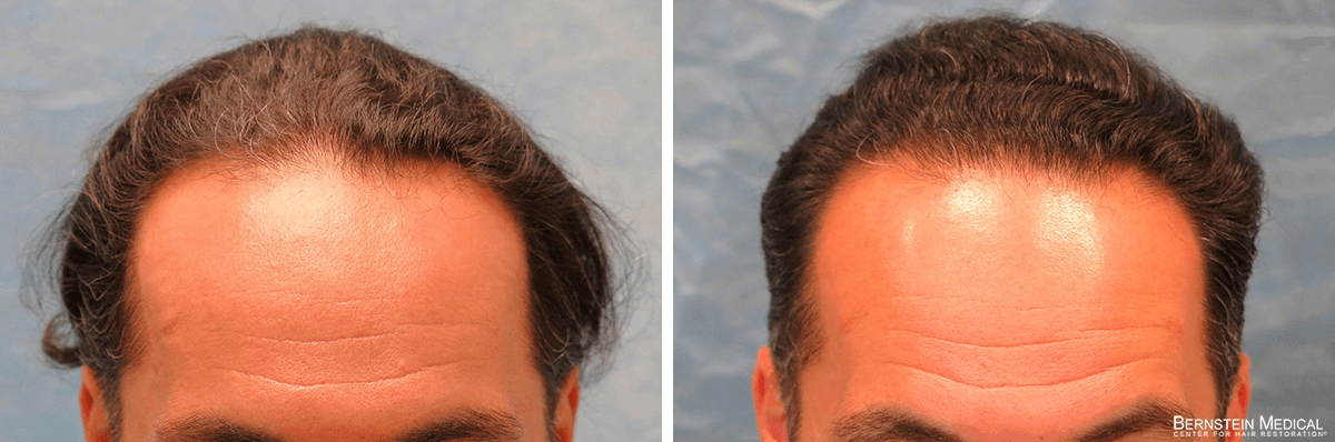 Bernstein Medical - Patient ZNQ Before and After Hair Transplant Photo