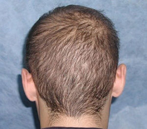 Let at læse krig Forfølgelse Case 4: Diffusely Thin Hair - Bernstein Medical - Center for Hair  Restoration