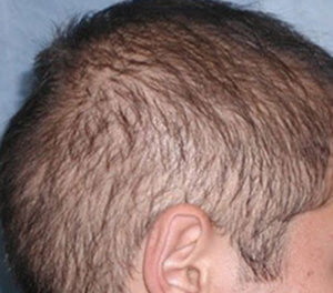 Case 4: Diffusely Thin Hair «