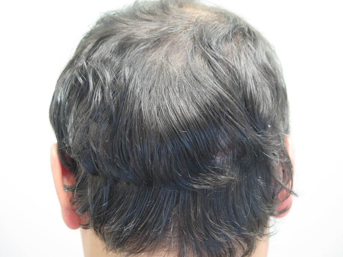 Long-Hair Robotic FUE | ARTAS Hair | Bernstein Medical Long-Hair Robotic FUE | ARTAS Hair | Bernstein Medical