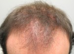 LPP in Male Pattern Alopecia