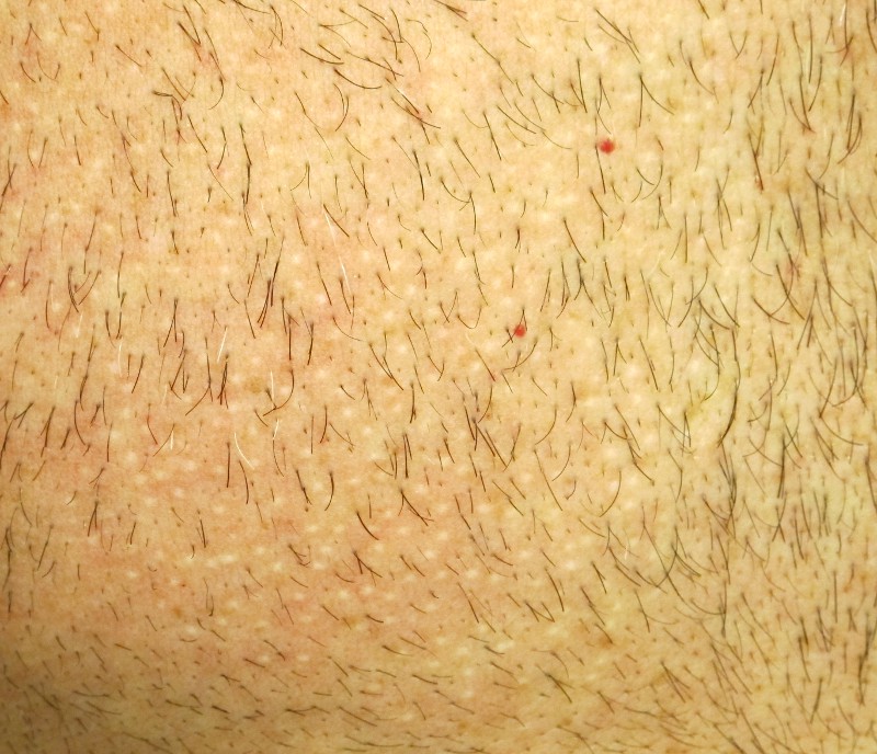 Does Body Hair Transplant Leave Scarring?