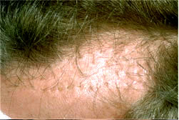 Scarred Skin from Large Grafts Before Camouflage