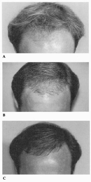 Rapid Fire Hair Implanter Carousel - Hair Transplant Results with Carousel