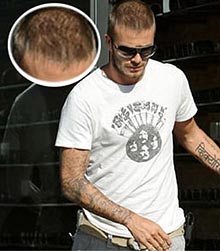 Celebrity Hair Transplants - David Beckham