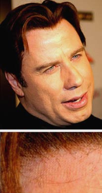 Celebrity Hair Transplants - John Travolta