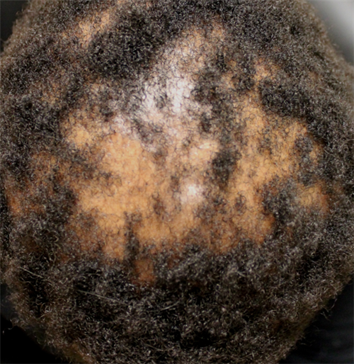 Central centrifugal cicatricial alopecia (CCCA) is a type of scarring alopecia that is typically seen in women of African descent