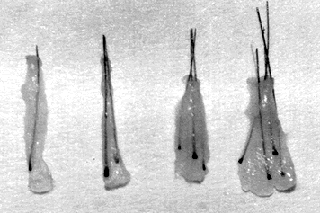 Classification of Hair Transplantation - One-, two-, three- and four-hair follicular units