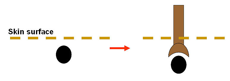Hair Cloning Methods - Implanting Dermal Papillae Cells Alone Hair Cloning Methods - Implanting Dermal Papillae Cells Alone