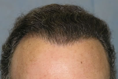 After Hair Restoration Using Combined Repair Techniques