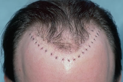 Hair Transplant Repair Techniques | Bernstein Medical