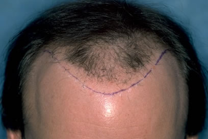 Position of Hairline Marked